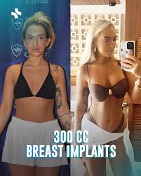 300cc Boob Job: Size, Results, Recovery, and What to Expect